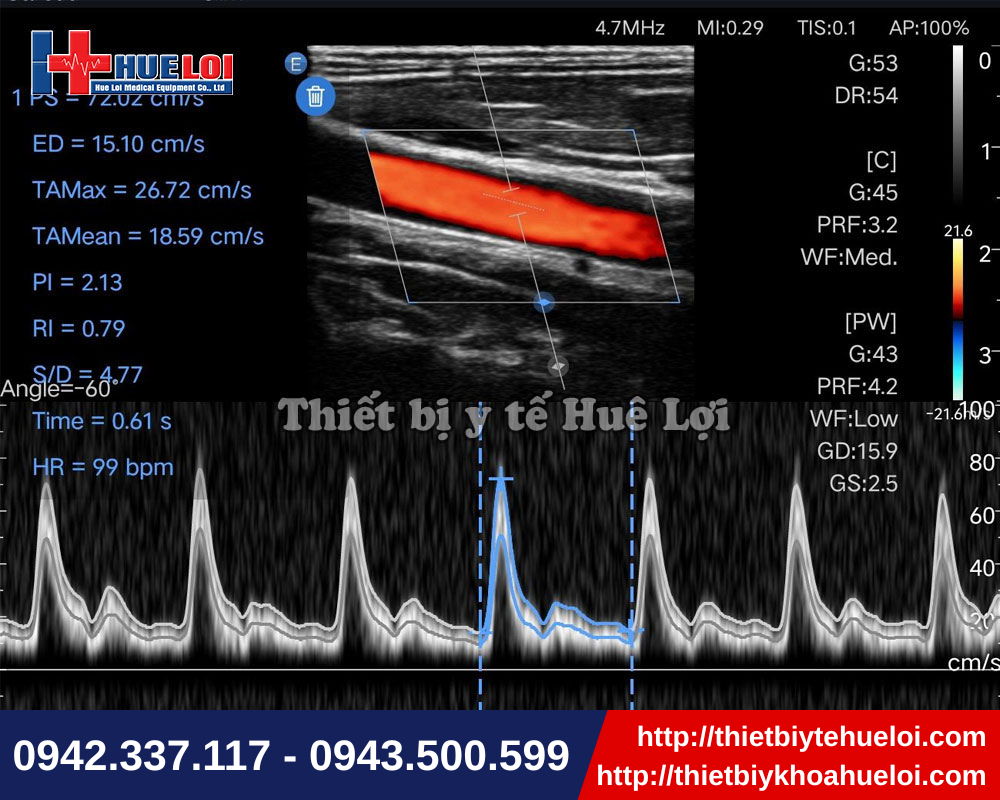 Máy siêu âm cầm tay đáp ứng chẩn đoán đa chuyên khoa
