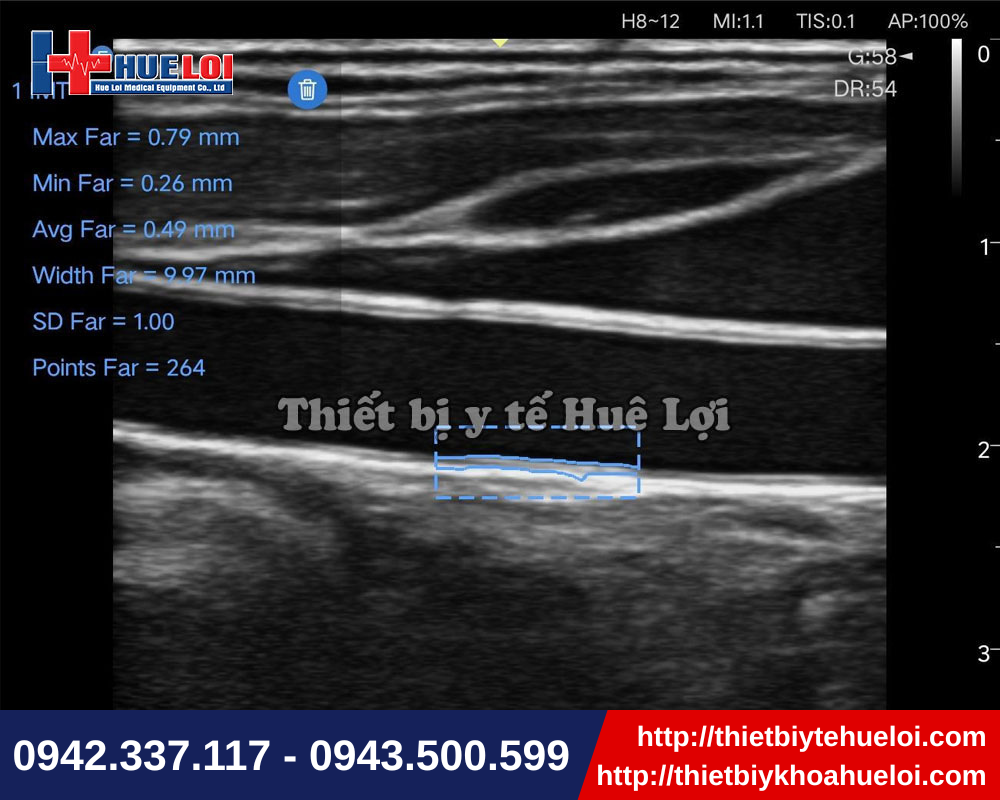 Máy siêu âm di động cho hình ảnh siêu âm mạch sắc nét
