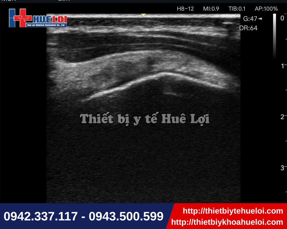 Máy siêu âm với đầu linear đáp ứng nhu cầu siêu âm cơ xương khớp