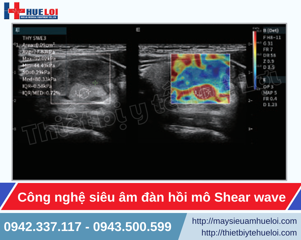 Công nghệ siêu âm đàn hồi mô Shear wave tích hợp trong máy siêu âm chẩn đoán hiện đại