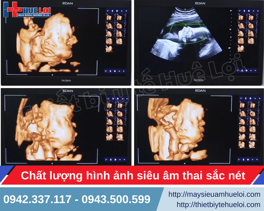 Máy siêu âm 5D EDAN LX85 mang lại hình ảnh thai nhi sắc nét