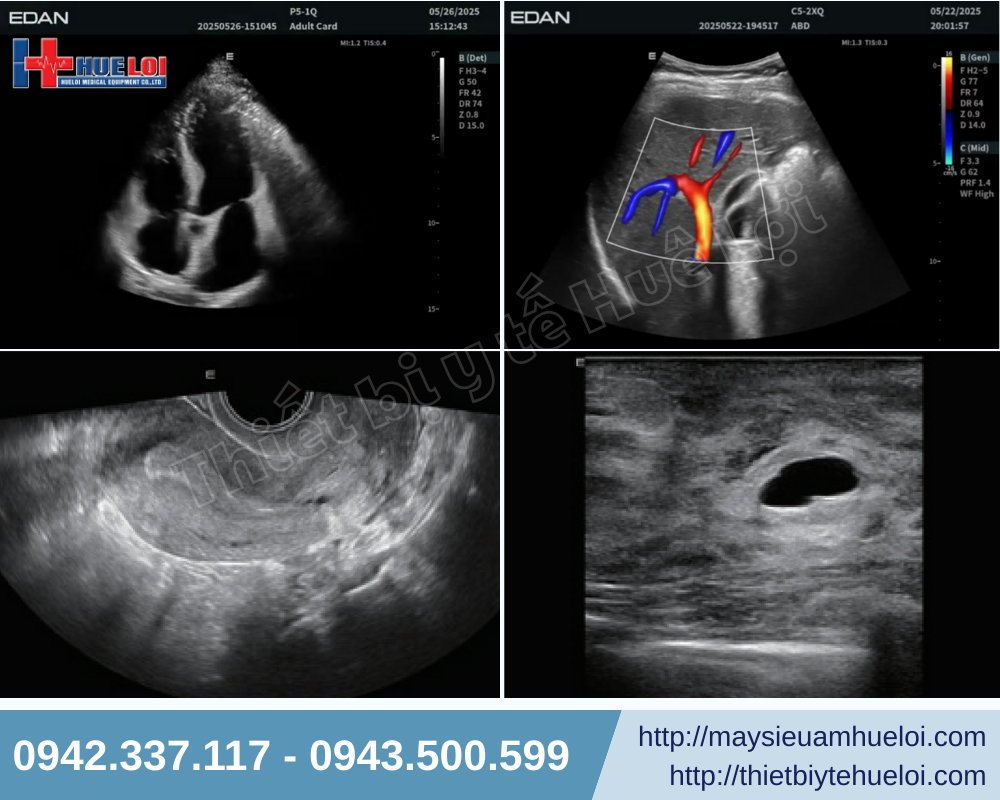 Công nghệ EDAN Synsight được tích hợp trong hệ thống siêu âm doppler màu - cải thiện chất lượng hình ảnh, nâng cao hiệu quả chẩn đoán 