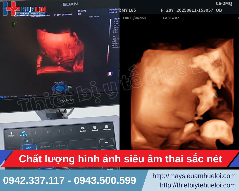 Công nghệ e- live của máy siêu âm 5D hiện đại giúp tái tạo khuôn mặt thai nhi sắc nét
