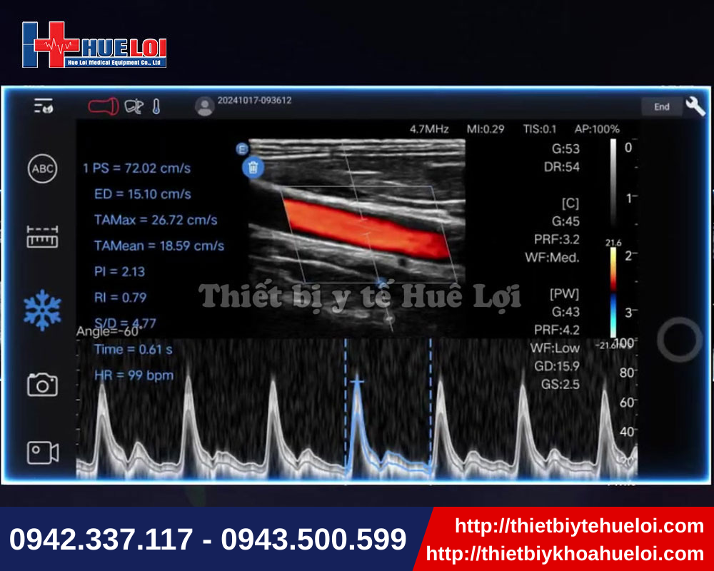 Chẩn đoán nhanh với máy siêu âm cầm tay hiện đại