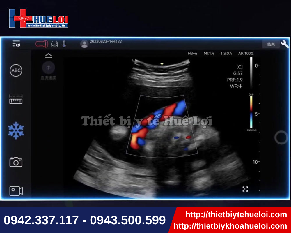 Công nghệ hình ảnh synsight tích hợp trên máy siêu âm bỏ túi nhỏ gọn