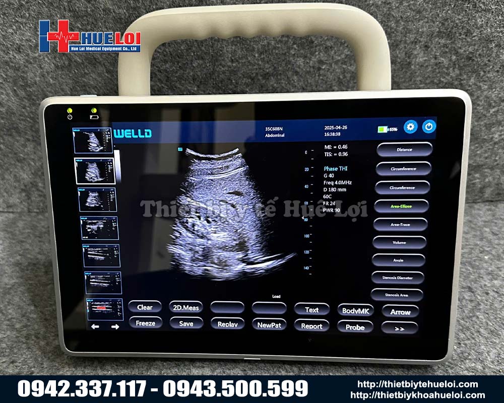 Máy siêu âm tuyến giáp xách tay