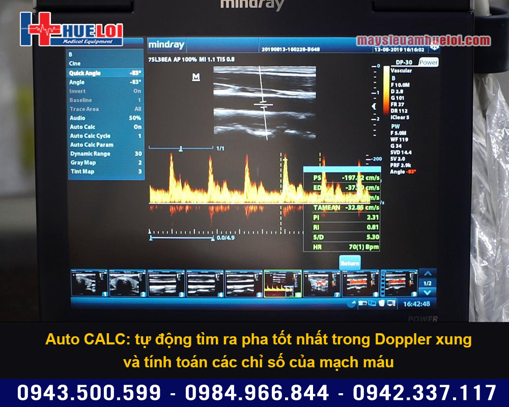 Tự động đo đạc trong chế độ PW Doppler