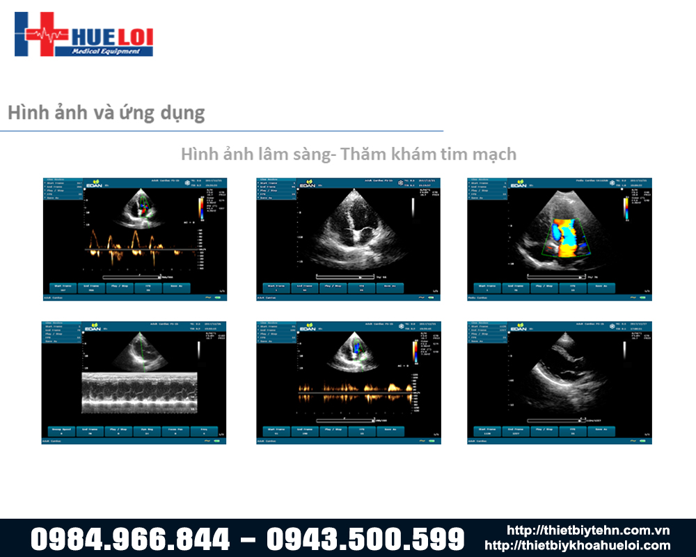 hinh-anh-tham-kham-tim-mach-edan-u60